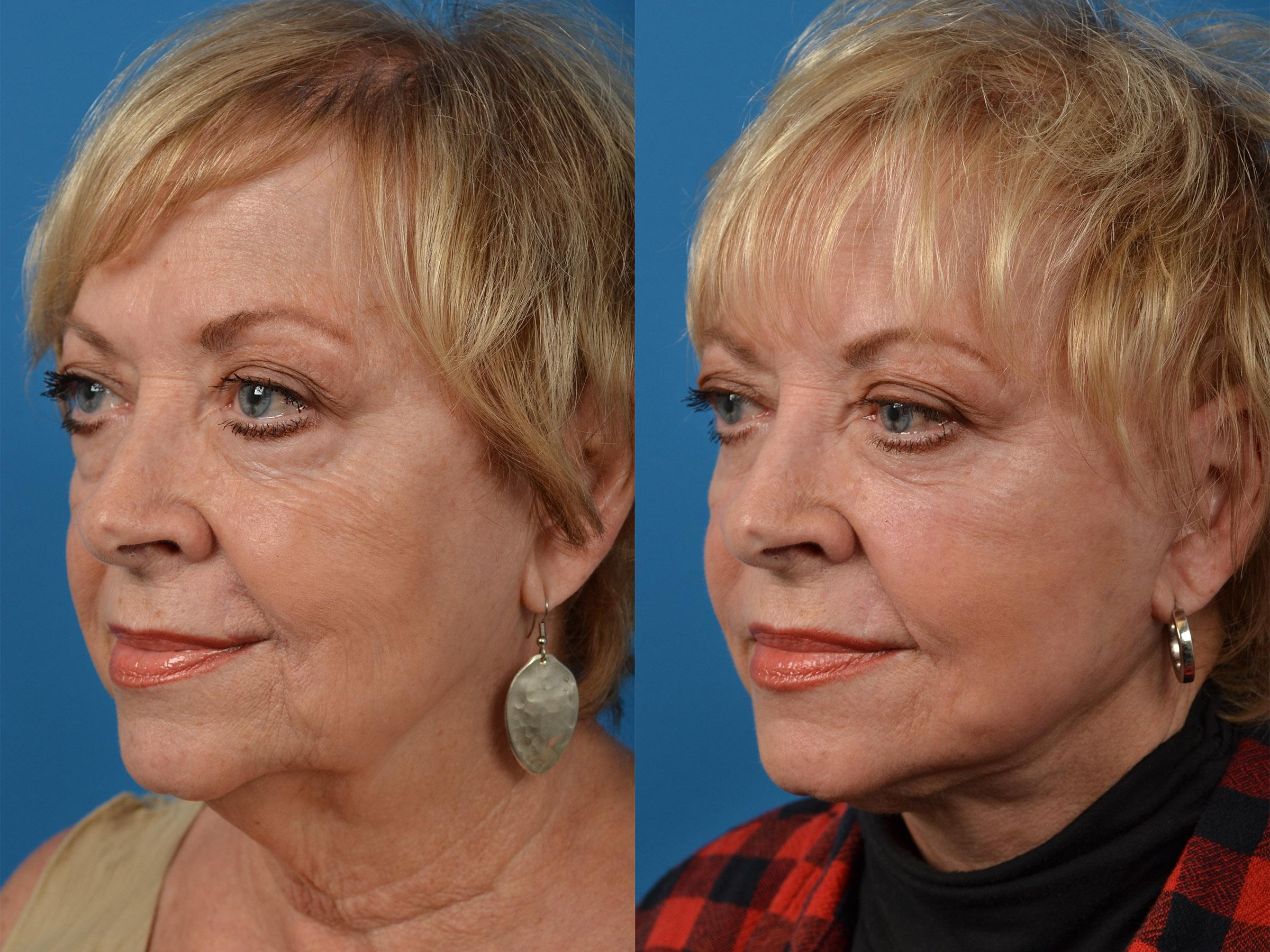 Filler Treatment Photos | Melbourne, FL | Patient 53623