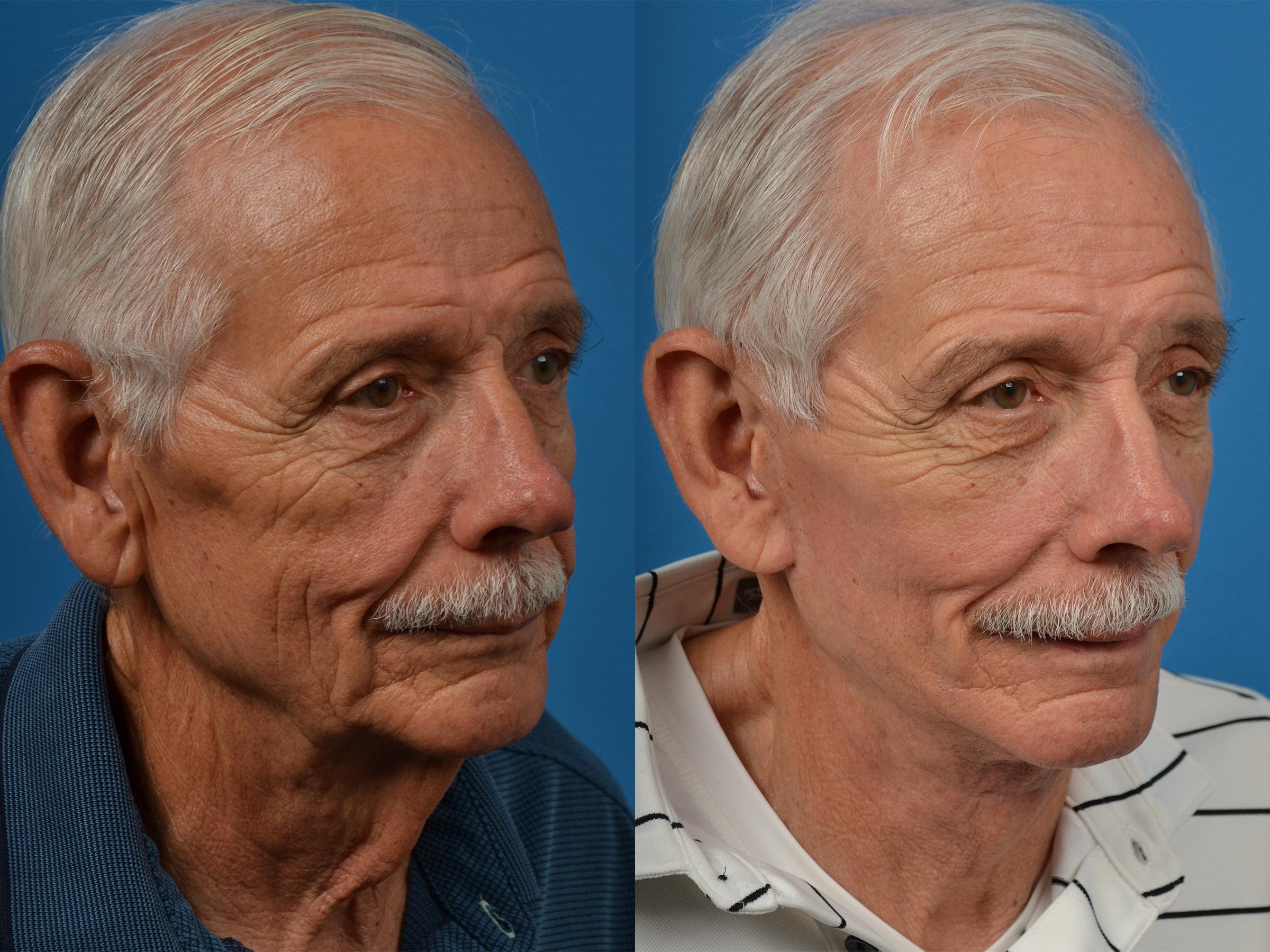 Mens Facelift Before And After
