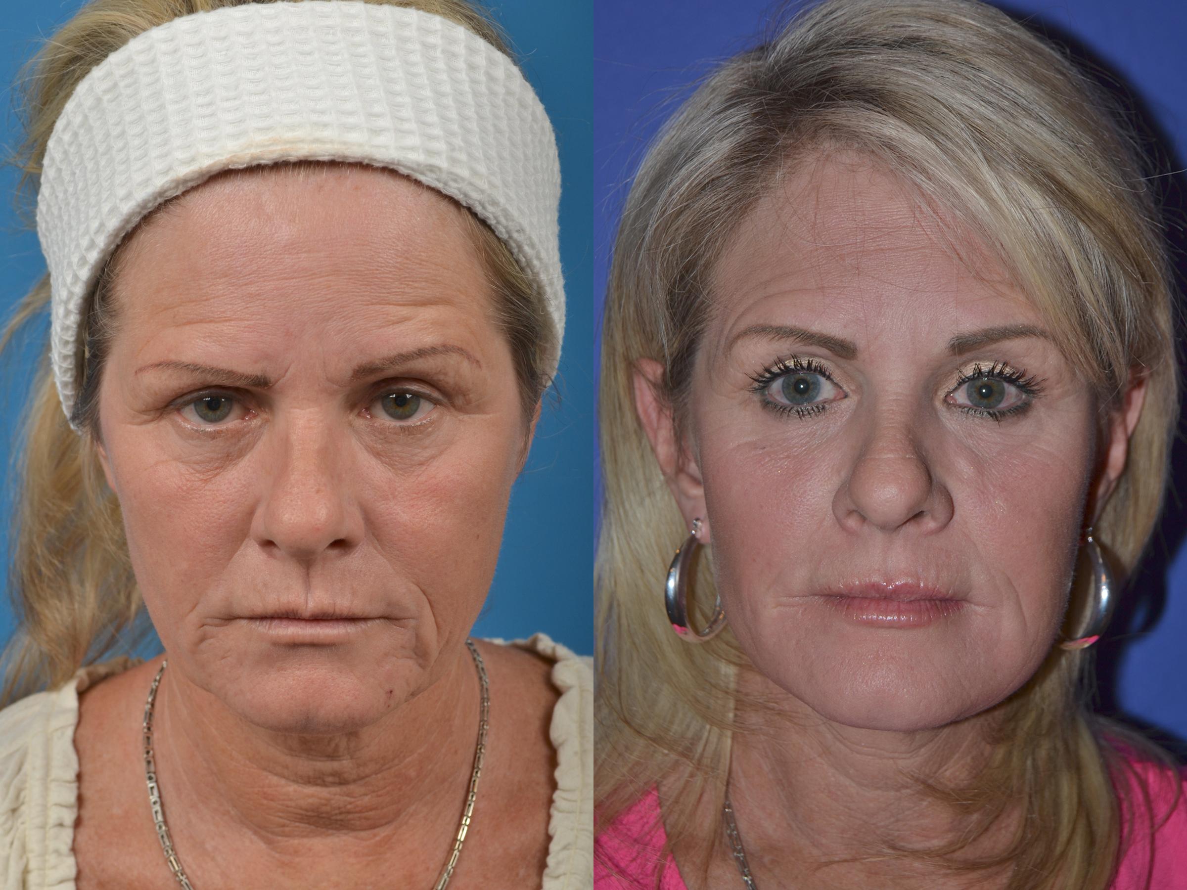 Facial Resurfacing: The Celebrity Skin Secret Revealed - nbkcn6h