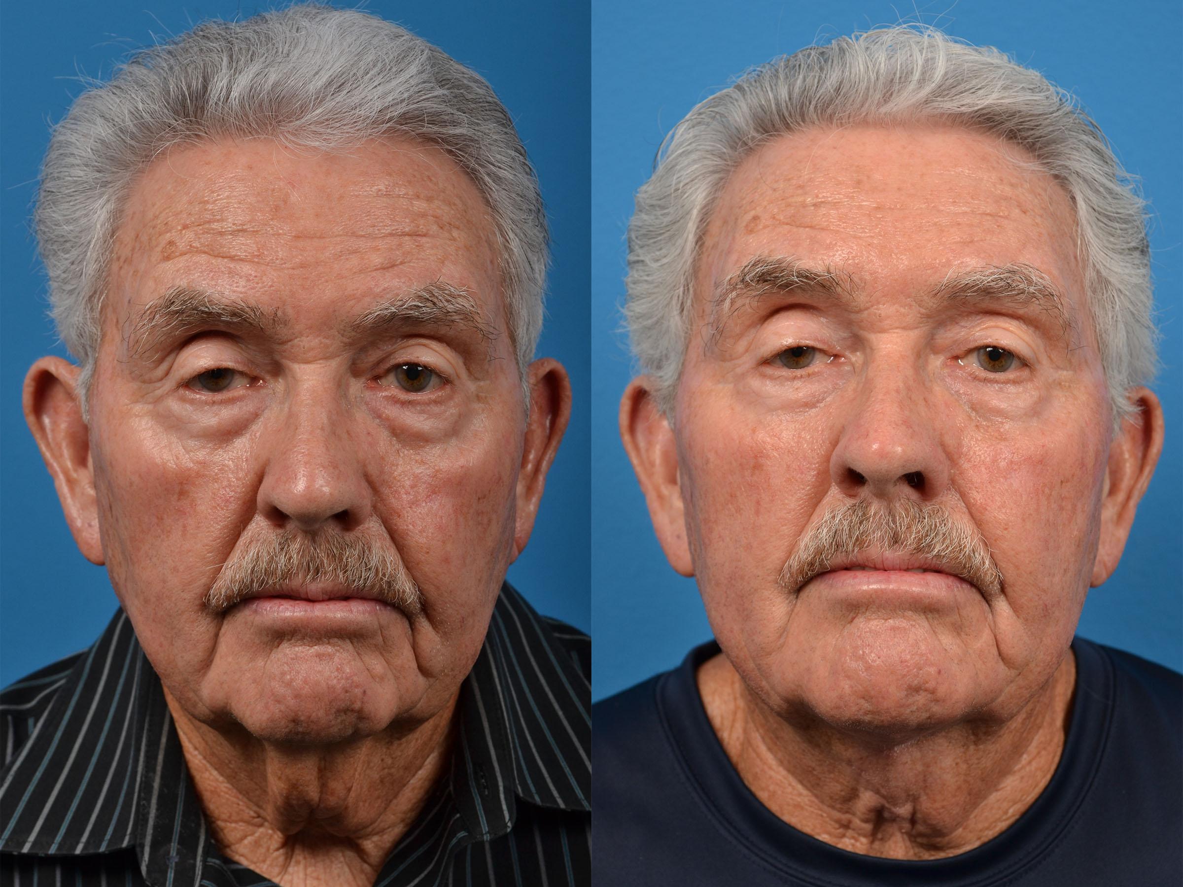 Male Neck Lift Photos Melbourne Fl Patient 56740