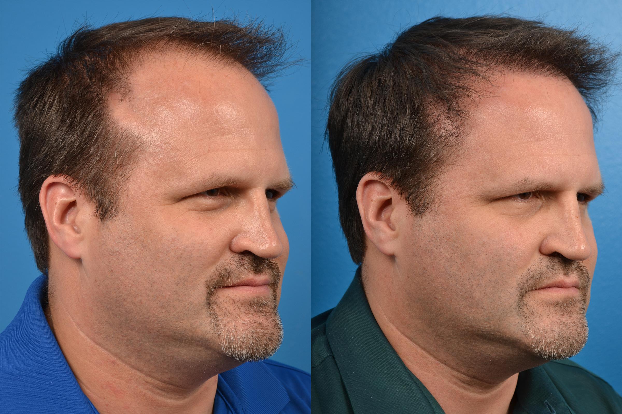 Hair Restoration Photos | Melbourne, FL | Patient 57533