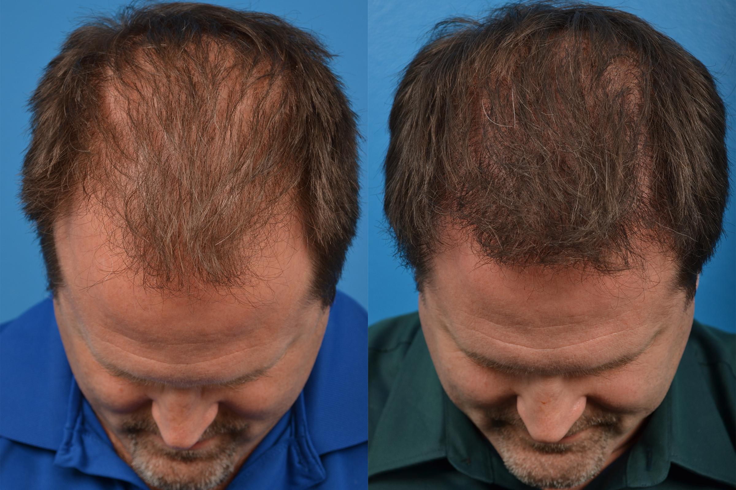 Hair Restoration Photos | Melbourne, FL | Patient 57533