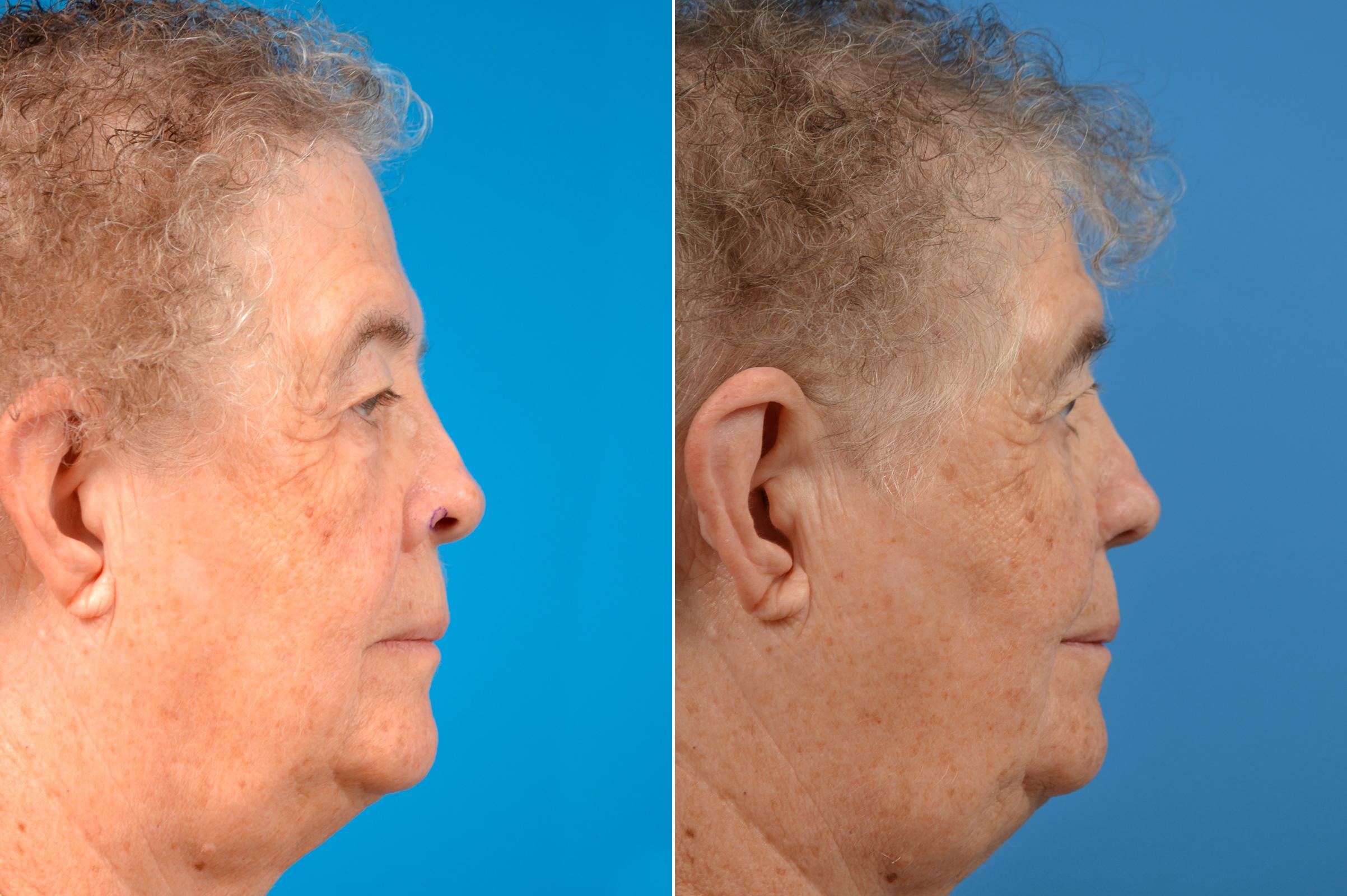 Mohs Surgery and Skin Cancer Photos Melbourne, FL