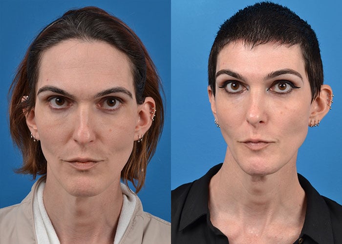 How Much Is A Facial Feminization Surgery