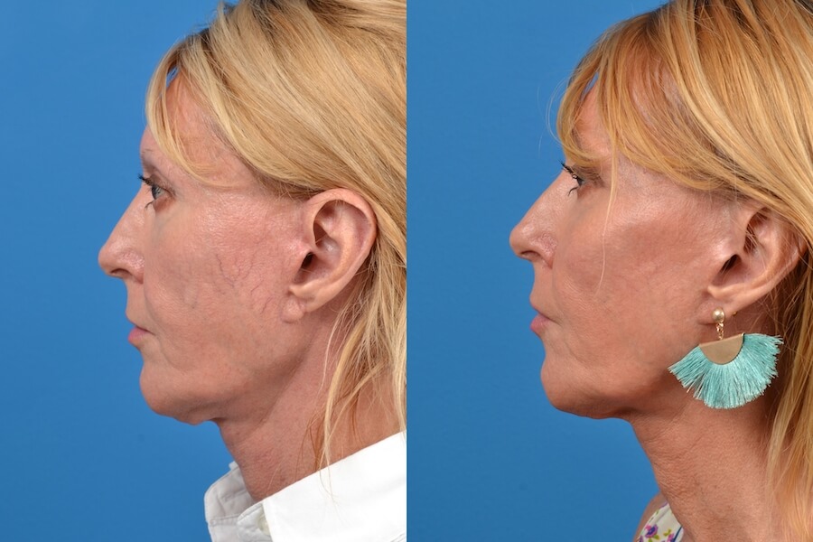 Levulan Photodynamic Therapy in Florida