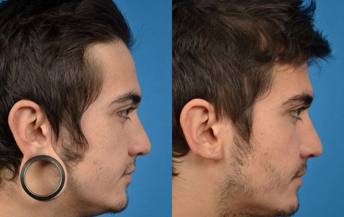 Earlobe Repair And Reconstruction Surgery In Florida 3183