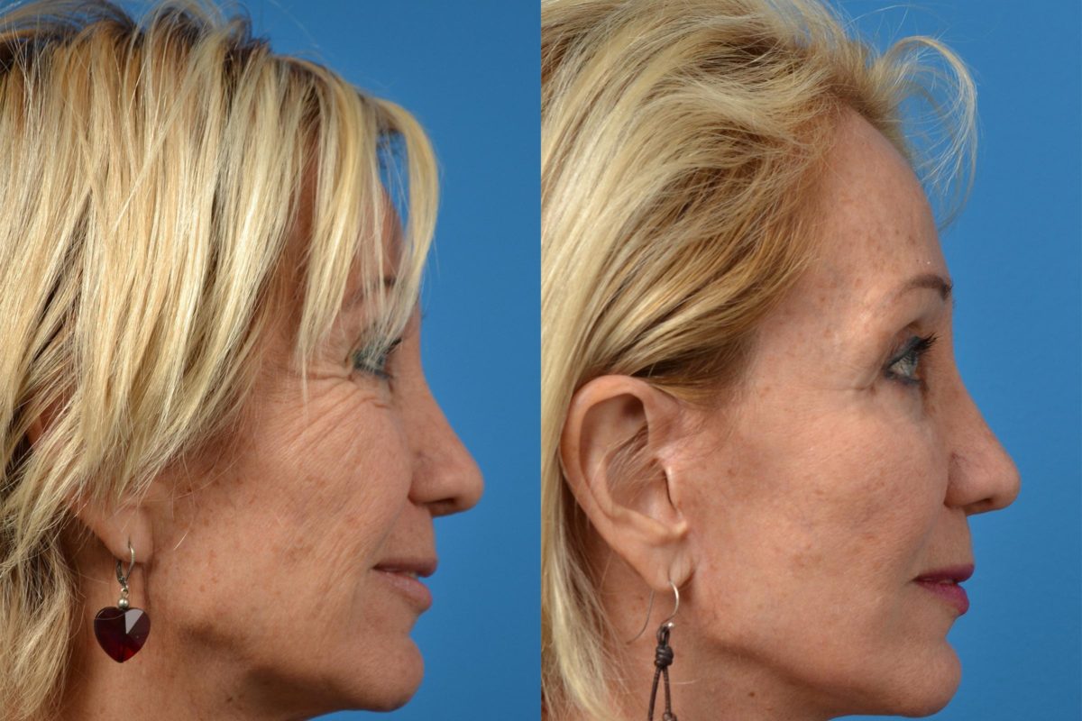 Filler Treatment Photos Melbourne, FL Patient 52595