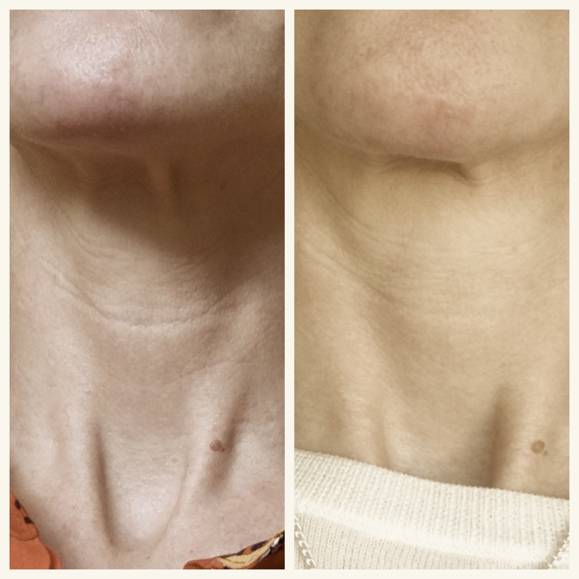  My neck before (left) and after treatment. The light's not the same, but you can see the change 