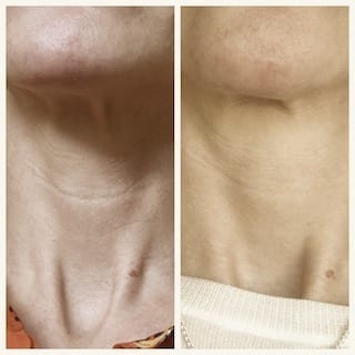 Profhilo-neck-before-and-after-2018-low-res