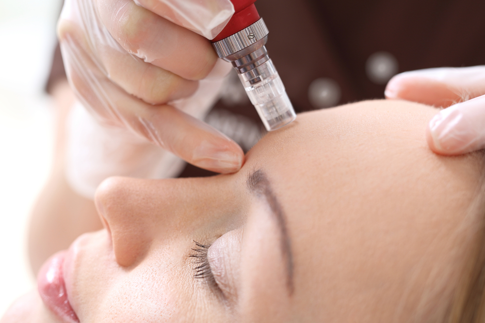 microneedling (alternative)