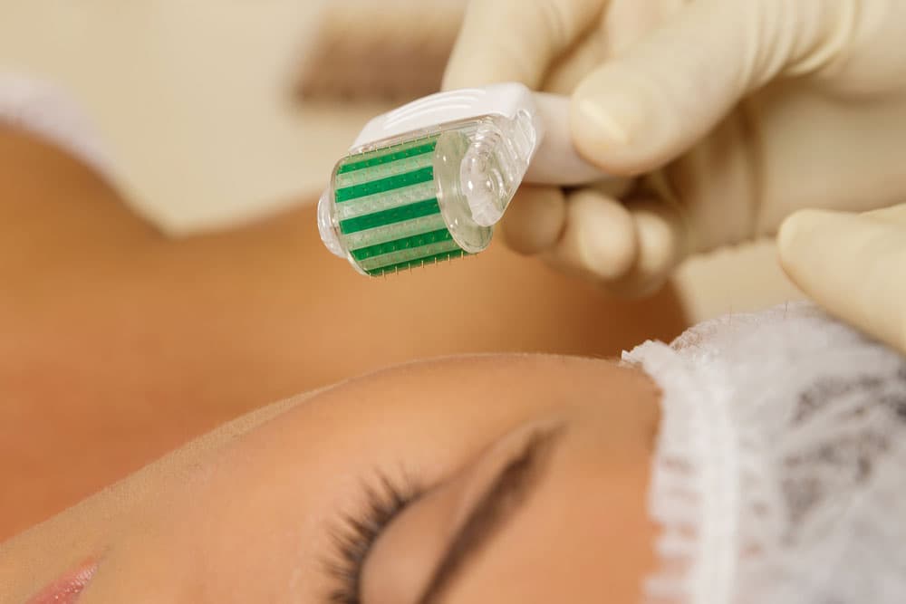 microneedling-2