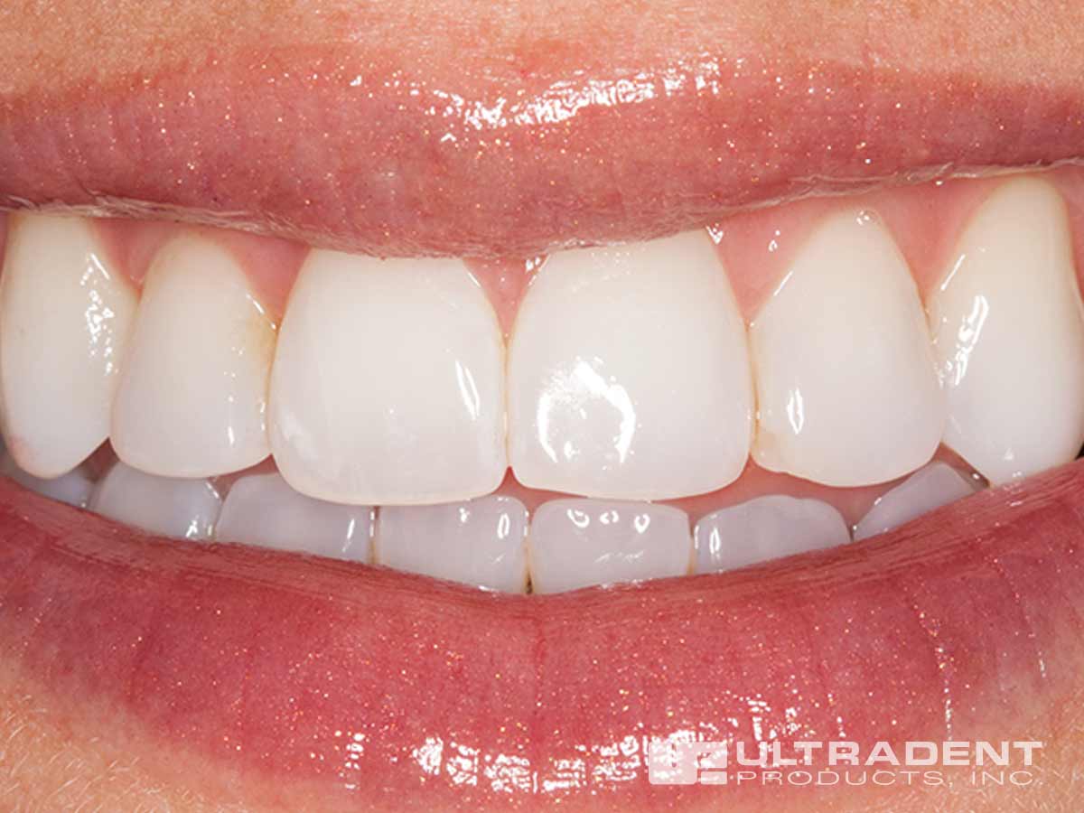 Enamelast Teeth Before Application.jpg