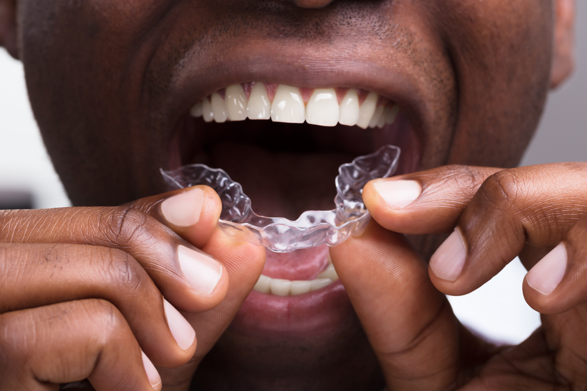 When should I start looking at braces or Invisalign clear aligners for my child?