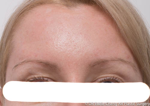 Anti Wrinkle Treatment Before And After Gallery Ar Plastic Surgery