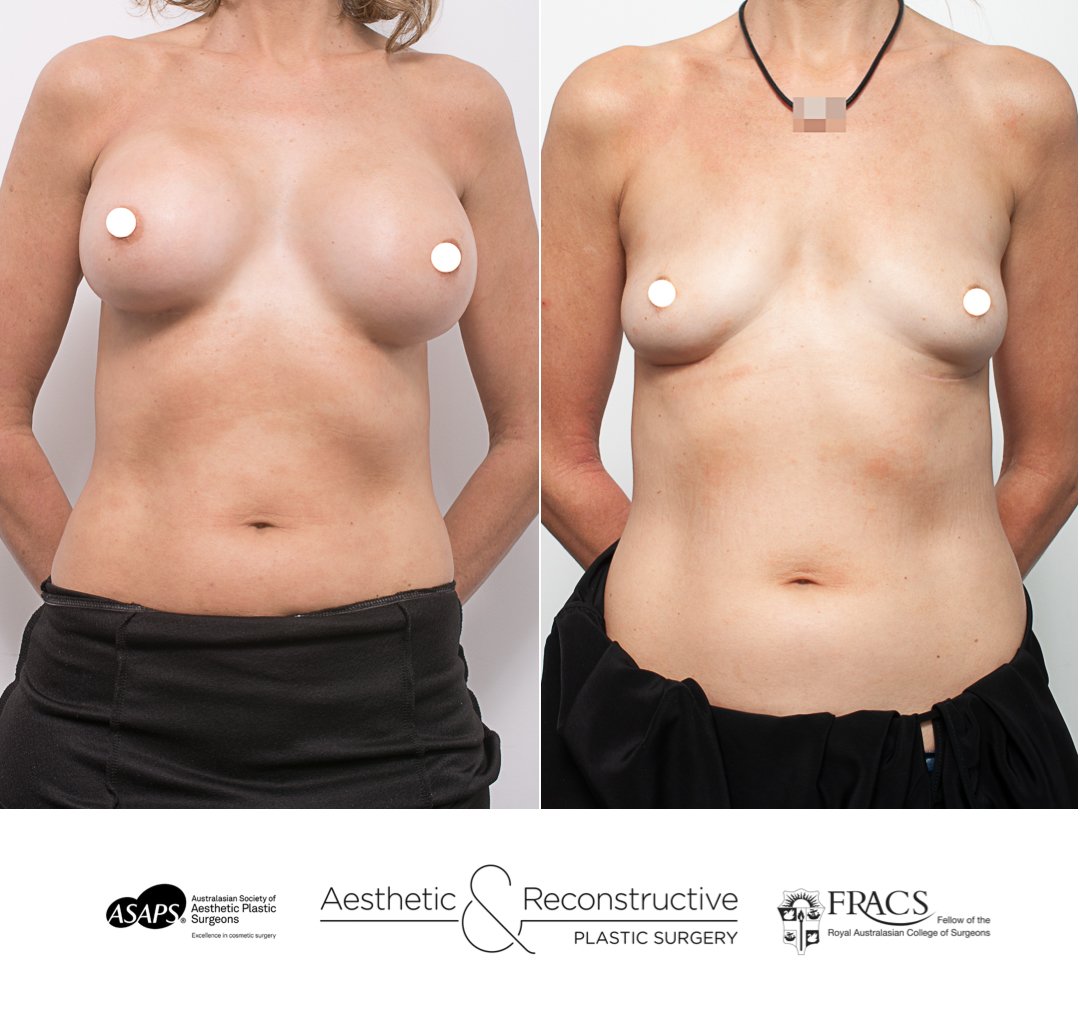 What You Should Know About Explant Surgery or Breast Implant Removal  Surgery?