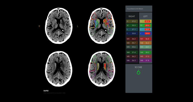 automatic-alberta-stroke-program-early-ct-score-aspects-using-ai