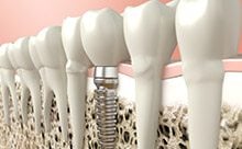 implants-3