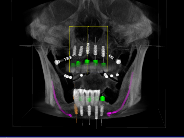 CT Scan for Implants