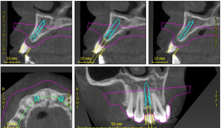 CT Guided Implant Not in Occlusion