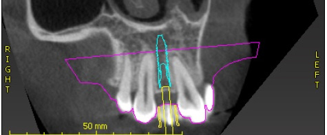 Implant Placement