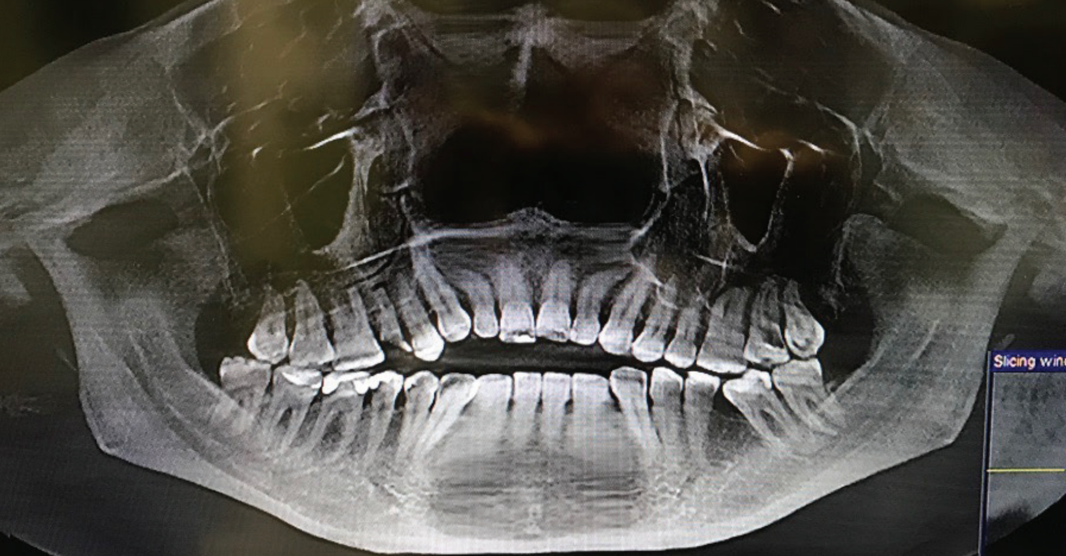 CT Scan on Airway disorders