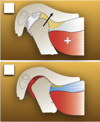 TMJ Yellow Joint