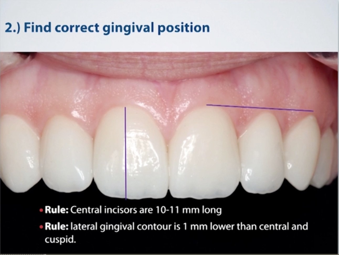 Correct Gingival Position