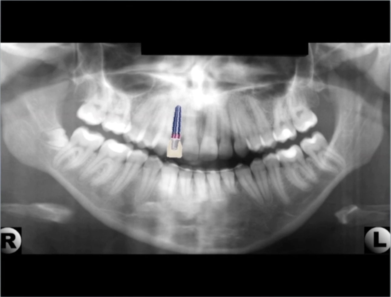 Lateral Incisor Implant