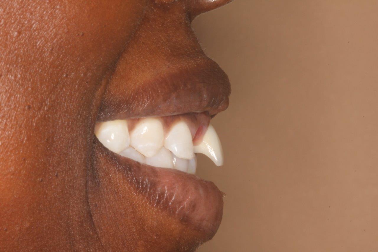 position of teeth affects speech