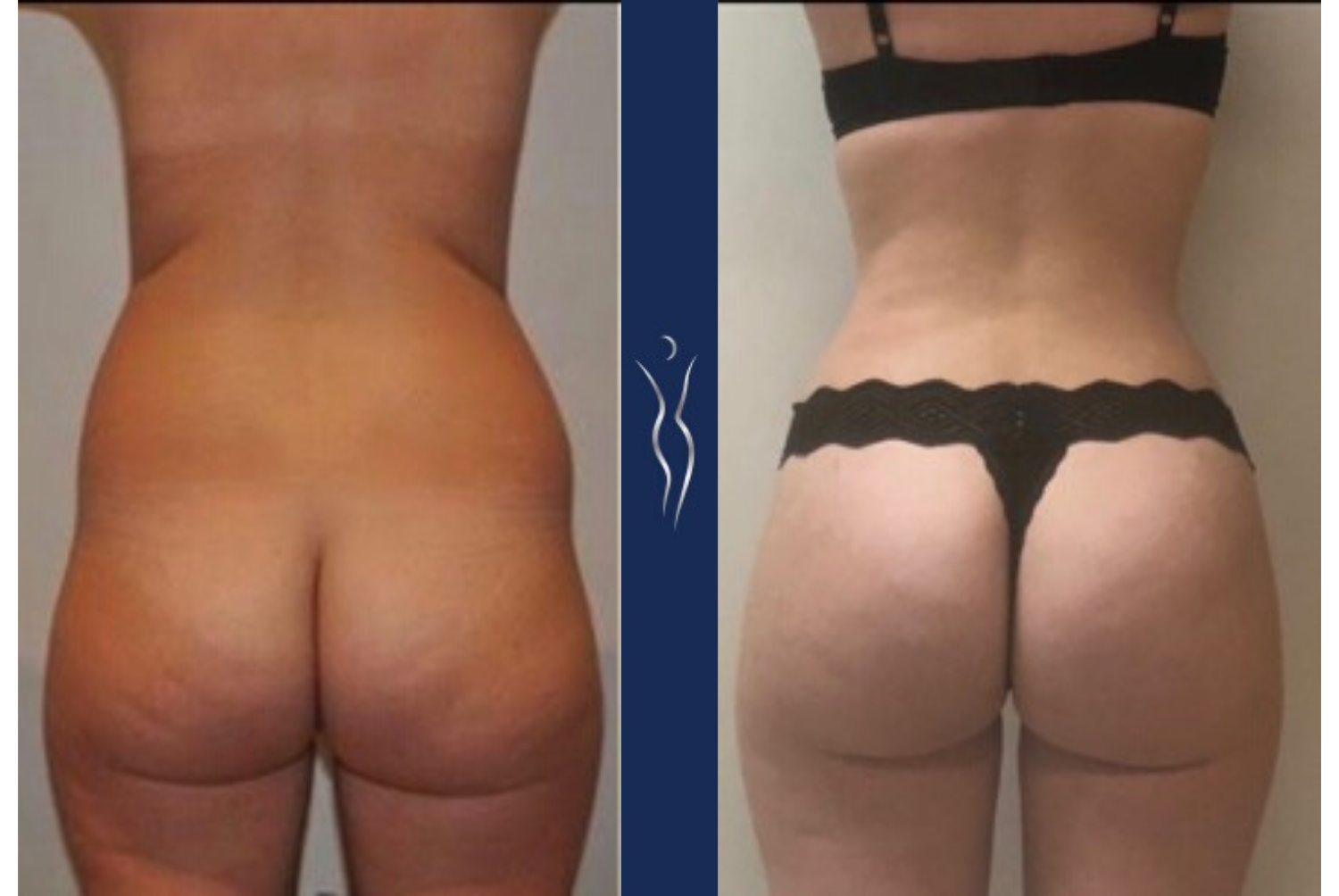What to Expect After Your Brazilian Butt Lift Surgery