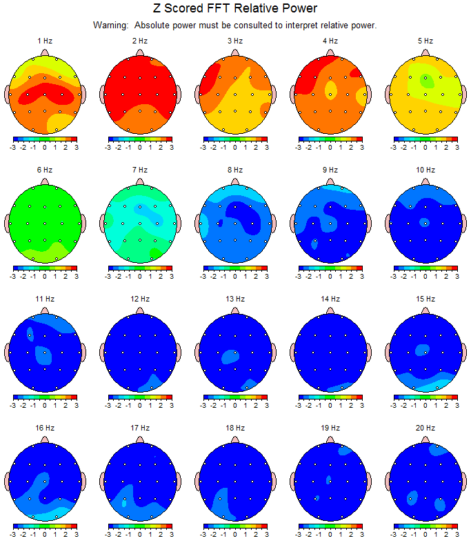 Сканирование мозга Мишель от февраля 2013 года. Синие области указывают на снижение уровня когнитивной активности.